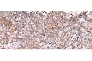 Immunohistochemistry of paraffin-embedded Human lung cancer tissue using TRMT12 Polyclonal Antibody at dilution of 1:80(x200)