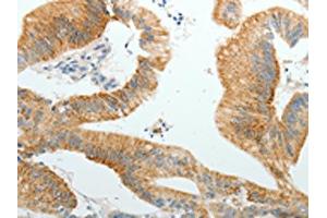 The image on the left is immunohistochemistry of paraffin-embedded Human colon cancer tissue using ABIN7191855(PGBD5 Antibody) at dilution 1/10, on the right is treated with synthetic peptide. (PGBD5 抗体)