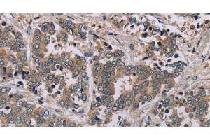 Immunohistochemistry of paraffin-embedded Human liver cancer tissue using AATK Polyclonal Antibody at dilution 1:45 (AATK 抗体)