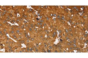 Immunohistochemistry of paraffin-embedded Human liver cancer tissue using RASSF3 Polyclonal Antibody at dilution 1:35 (RASSF3 抗体)
