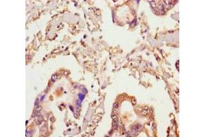 Immunohistochemistry of paraffin-embedded human pancreatic cancer using ABIN7141994 at dilution of 1:100