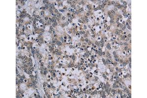 Immunohistochemistry of Human lung cancer using TP53AIP1 Polyclonal Antibody at dilution of 1:50 (TP53AIP1 抗体)