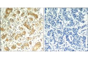 Immunohistochemical analysis of paraffin-embedded human breast carcinoma tissue using syk (Ab-323) Antibody (E021546). (SYK 抗体)