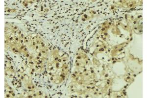 ABIN6267097 at 1/100 staining Human breast cancer tissue by IHC-P. (Beclin 1 抗体  (pSer15))