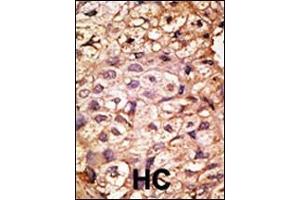 Formalin-fixed and paraffin-embedded human cancer tissue reacted with the primary antibody, which was peroxidase-conjugated to the secondary antibody, followed by AEC staining. (ACE2 抗体  (N-Term))