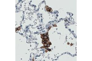 Immunohistochemical staining (Formalin-fixed paraffin-embedded sections) of human lung with MRC1 monoclonal antibody, clone CL0387  shows strong immunoreactivity in macrophages. (Macrophage Mannose Receptor 1 抗体)