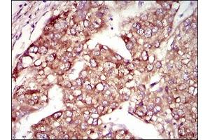 Immunohistochemical analysis of paraffin-embedded liver cancer tissues using MAP1LC3A mouse mAb with DAB staining. (MAP1LC3A 抗体  (AA 1-121))