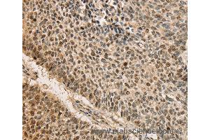 Immunohistochemistry of Human lung cancer using CDCA8 Polyclonal Antibody at dilution of 1:40 (CDCA8 抗体)