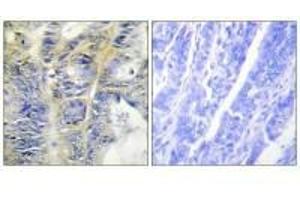 Immunohistochemistry analysis of paraffin-embedded human colon carcinoma tissue using Collagen IV α5 antibody. (COL4a5 抗体)