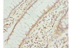 Immunohistochemistry of paraffin-embedded human colon cancer using ABIN7166573 at dilution of 1:100 (COX1 抗体  (AA 1-160))