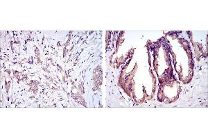 Immunohistochemical analysis of paraffin-embedded breast cancer tissues (left) and prostate tissues (right) using MAP3K5 mouse mAb with DAB staining. (ASK1 抗体)