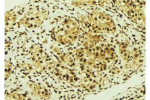 ABIN6276841 at 1/100 staining Human breast cancer tissue by IHC-P. (MED1 抗体  (Internal Region))