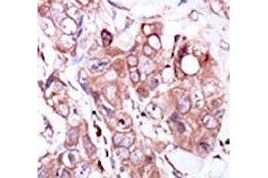 IHC analysis of FFPE human breast carcinoma tissue stained with the ERBB4 antibody (ERBB4 抗体  (AA 1276-1308))