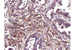 Formalin-fixed and paraffin embedded human lung carcinoma labeled with Anti-MDR1/p-GP/CD243 Polyclonal Antibody (ABIN670161), Unconjugated 1:200 at 1:200, followed by conjugation to the secondary antibody and DAB staining (ATP-Binding Cassette, Sub-Family B (MDR/TAP), Member 1B (ABCB1B) (AA 21-100) 抗体)