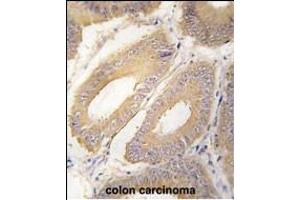 Formalin-fixed and paraffin-embedded human colon carcinoma tissue reacted with FGF4 Antibody (C-term) (ABIN392776 and ABIN2842218) , which was peroxidase-conjugated to the secondary antibody, followed by DAB staining. (FGF4 抗体  (C-Term))