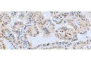 Immunohistochemistry of paraffin-embedded Human thyroid cancer tissue using TCF19 Polyclonal Antibody at dilution of 1:60(x200) (TCF19 抗体)