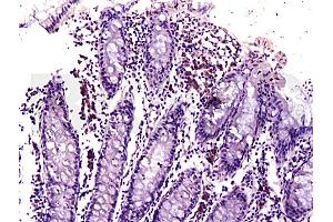 Formalin-fixed and paraffin embedded human colon labeled with Anti-DR3/APO3/TWEAK Polyclonal Antibody, Unconjugated (ABIN668421) at 1:200, followed by conjugation to the secondary antibody and DAB staining (DR3/LARD 抗体  (AA 351-417))