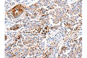 The image on the left is immunohistochemistry of paraffin-embedded Human breast cancer tissue using ABIN7190683(FOXD2 Antibody) at dilution 1/10, on the right is treated with synthetic peptide. (FOXD2 抗体)
