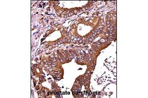 RIPK1 Antibody (N-term) ((ABIN657814 and ABIN2846781))immunohistochemistry analysis in formalin fixed and paraffin embedded human prostate carcinoma followed by peroxidase conjugation of the secondary antibody and DAB staining. (RIPK1 抗体  (N-Term))