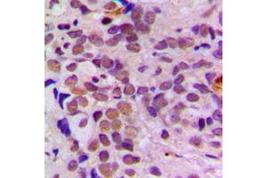 Immunohistochemical analysis of ATF1 staining in human breast cancer formalin fixed paraffin embedded tissue section. (AFT1 抗体  (C-Term))