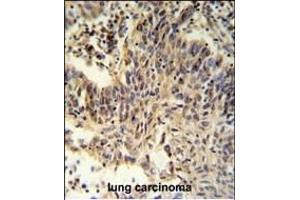 RXRA Antibody (Center) (ABIN651113 and ABIN2840079) IHC analysis in formalin fixed and paraffin embedded lung carcinoma followed by peroxidase conjugation of the secondary antibody and DAB staining. (Retinoid X Receptor alpha 抗体  (AA 196-224))