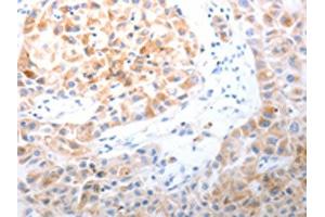 The image on the left is immunohistochemistry of paraffin-embedded Human lung cancer tissue using ABIN7191313(LPPR5 Antibody) at dilution 1/20, on the right is treated with synthetic peptide. (LPPR5 抗体)