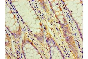 Immunohistochemistry of paraffin-embedded human colon cancer using ABIN7171365 at dilution of 1:100 (CD2 抗体  (AA 25-209))