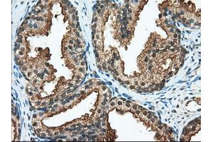 Immunohistochemical staining of paraffin-embedded Adenocarcinoma of Human ovary tissue using anti-RANGAP1 mouse monoclonal antibody. (RANGAP1 抗体)