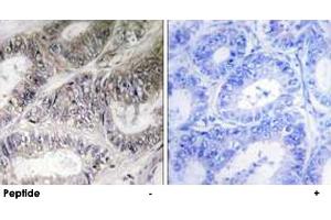 Immunohistochemistry analysis of paraffin-embedded human colon carcinoma tissue using COX19 polyclonal antibody . (COX19 抗体)
