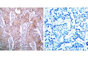 Immunohistochemical analysis of paraffin- embedded breast carcinoma, using EGFR (Phospho-Ser1070) Antibody. (EGFR 抗体  (pSer1070))