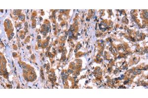 Immunohistochemistry of paraffin-embedded Human breast cancer tissue using HRG Polyclonal Antibody at dilution 1:50 (HRG 抗体)
