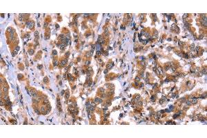 Immunohistochemistry of paraffin-embedded Human breast cancer tissue using HRG Polyclonal Antibody at dilution 1:50 (HRG 抗体)