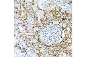 Immunohistochemistry of paraffin-embedded human lung cancer using MUC1 Rabbit mAb (ABIN7268687) at dilution of 1:100 (40x lens). (MUC1 抗体)