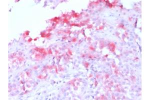 Formalin-fixed, paraffin-embedded human Melanoma stained with MART-1 Rabbit Recombinant Monoclonal Antibody (MLANA/1761R) (AP-Fast Red). (Recombinant MLANA 抗体)