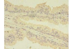 Immunohistochemistry of paraffin-embedded human prostate cancer using ABIN7173738 at dilution of 1:100 (TBCA 抗体  (AA 2-108))