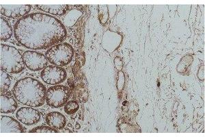 Immunohistochemistry of paraffin-embedded Human colon carcinoma tissue using HSPA5 Monoclonal Antibody at dilution of 1:200.