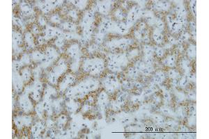 Immunoperoxidase of monoclonal antibody to C1GALT1 on formalin-fixed paraffin-embedded human hepatocellular carcinoma.