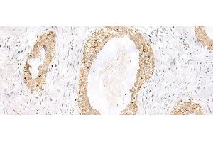 Immunohistochemistry of paraffin-embedded Human breast cancer tissue using TOR1A Polyclonal Antibody at dilution of 1:35(x200) (TOR1A 抗体)