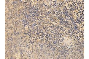 ABIN6256253 and ABIN6267488 at 1/100 staining human melanoma by IHC-P.