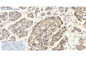 Immunohistochemistry of paraffin-embedded Human stomach cancer tissue using CD284 Polyclonal Antibody at dilution of 1:200. (TLR4 抗体)