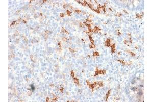 Formalin-fixed, paraffin-embedded human Melanoma stained with NGFR Rabbit Recombinant Monoclonal Antibody (NGFR/1997R). (Recombinant NGFR 抗体)
