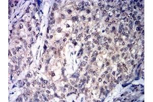 Immunohistochemical analysis of paraffin-embedded cervical cancer tissues using SDHB mouse mAb with DAB staining. (SDHB 抗体  (AA 29-280))