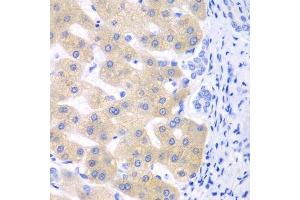 Immunohistochemistry of paraffin-embedded human liver cancer using CYP2C18 antibody. (CYP2C18 抗体  (AA 231-490))