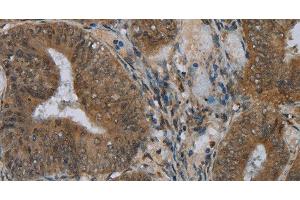 Immunohistochemistry of paraffin-embedded Human colon cancer using NAT10 Polyclonal Antibody at dilution of 1:40 (NAT10 抗体)