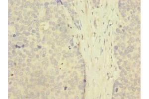 Immunohistochemistry of paraffin-embedded human gastric cancer using ABIN7176509 at dilution of 1:100 (ZNF77 抗体  (AA 51-369))