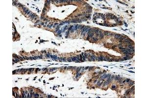 Immunohistochemical staining of paraffin-embedded Adenocarcinoma of colon tissue using anti-FAHD2Amouse monoclonal antibody. (FAHD2A 抗体)