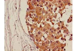 Immunohistochemistry of paraffin-embedded human breast cancer using ABIN7146220 at dilution of 1:100 (CDH18 抗体  (AA 66-251))