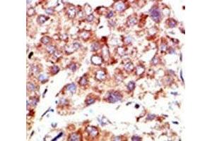 IHC analysis of FFPE human hepatocarcinoma stained with the NEDD8 antibody