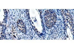 Immunohistochemistry of paraffin-embedded Human cervical cancer tissue using TRIM23 Polyclonal Antibody at dilution of 1:55(x200) (TRIM23 抗体)