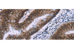 Immunohistochemistry of paraffin-embedded Human colon cancer tissue using HMGA1 Polyclonal Antibody at dilution 1:30 (HMGA1 抗体)
